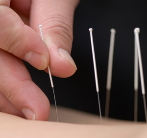 Hand putting needles into skin
